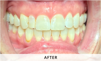 Invisalign gallery