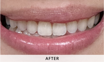 Invisalign gallery