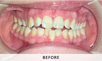 Invisalign gallery