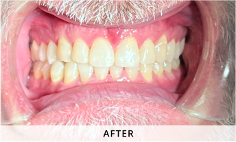 Invisalign gallery