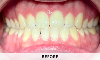 Invisalign gallery