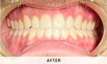Invisalign gallery