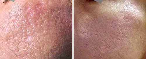Laser acne treatment before and after on lower cheek