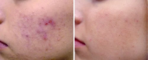 Before and after acne laser treatment on cheek