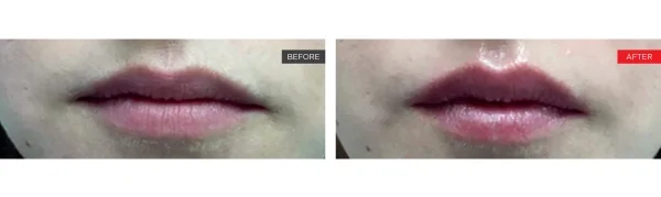 LipLase treatment before and after showing fuller lips