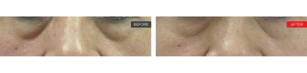 SmoothEye laser treatment before and after under-eye bag reduction