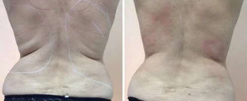 TightSculpting back contouring before and after with treatment markings