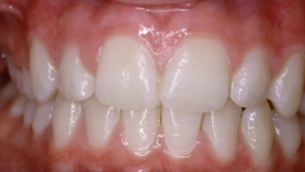Teeth after HealthyStart treatment
