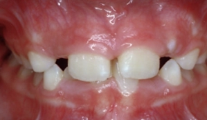Malformed dental arches